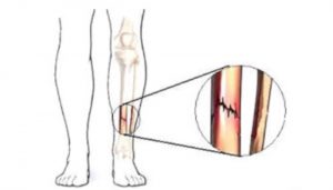 FRACTURAS POR ESTRES