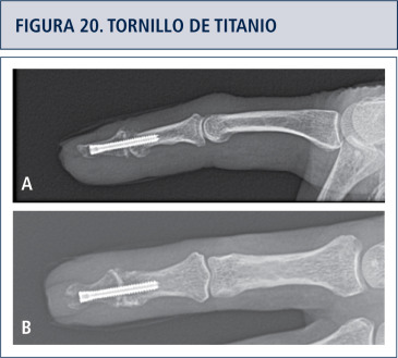 Nódulos heberden Bouchard